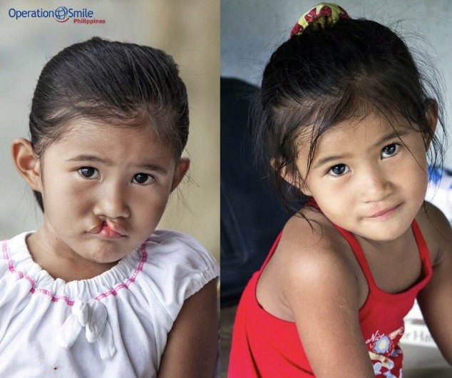 A girl before and after her free cleft surgery