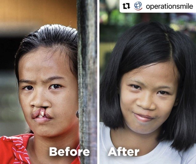 Before and after — a child helped by Operation Smile Philippines
