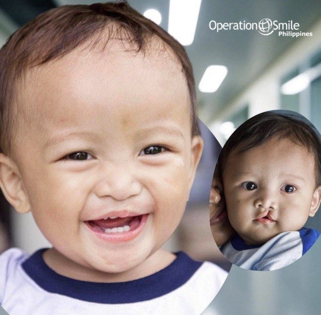 A smiling baby boy after his cleft surgery